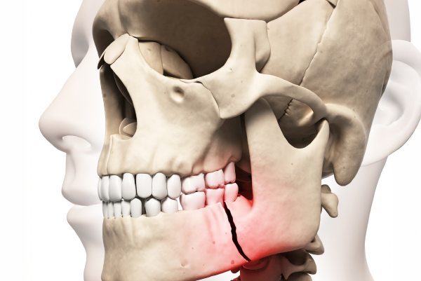 Ein Modell eines Kieferbruchs.